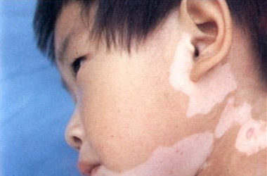 武汉北大白癜风医院介绍引起儿童白癜风的发病原因有哪些?