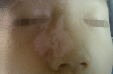 湖北患者问白斑病长在脸上怎么办